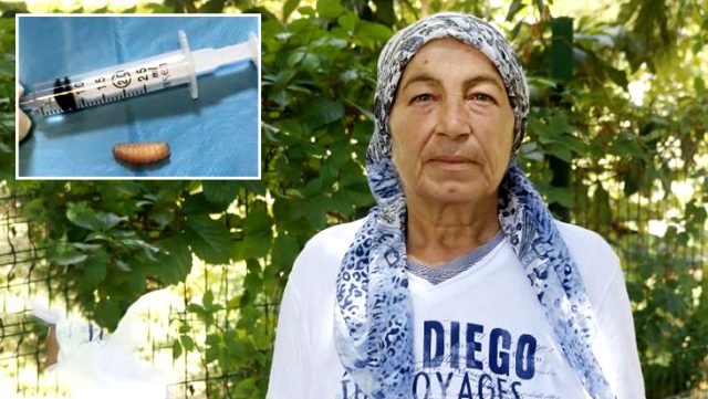 Burun akıntısı şikayetiyle hastaneye başvuran kadının sinüslerinden 11 kurtçuk çıktı