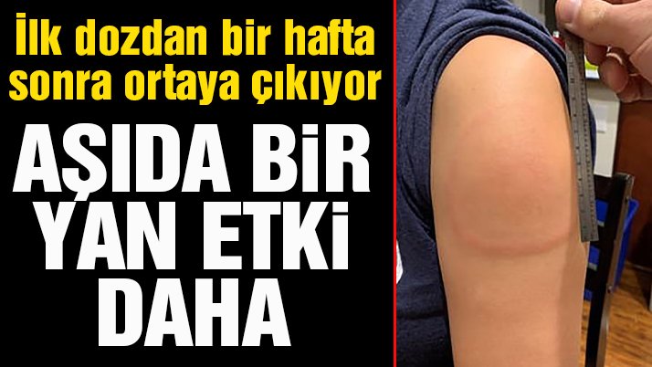 Moderna’nın corona aşısında bir yan etki daha