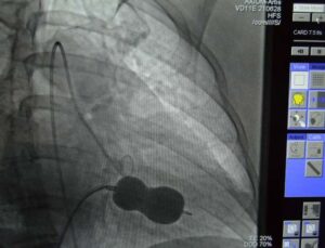 Alanya’da mitral kapak darlığı ameliyatsız tedavi edildi