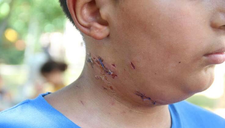 Köpek saldırısına uğrayan 10 yaşındaki çocuk ölümden döndü