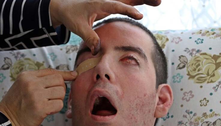 Görme bozukluğuyla başladı, 10 yıldır gözlerini kapatamıyor